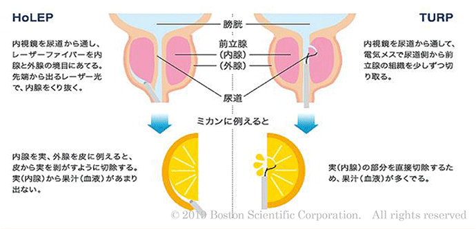 HoLEPとTUR-Pのイメージ比較